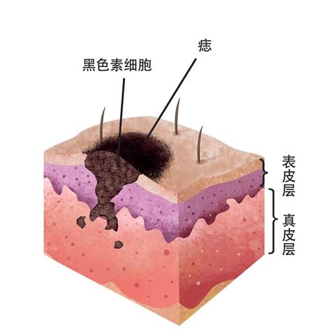 痣是如何形成的|痣形成的原因？痣長毛、痣變多變大是痣病變？5招判。